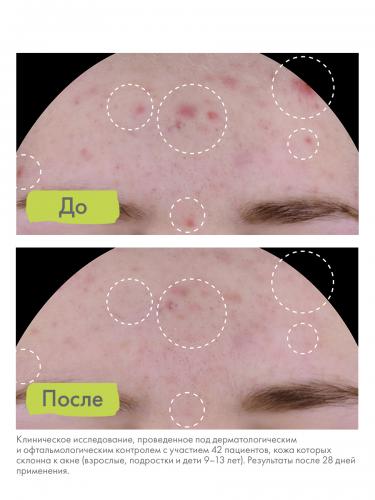 Адерма Крем для комплексного ухода за проблемной кожей AC Global, 40 мл (A-Derma, Biology), фото-5